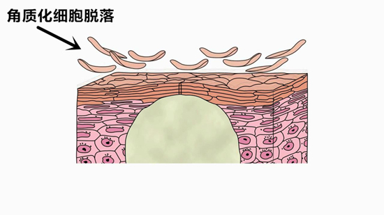 肤质不同，可别乱去角质！小心毁容！